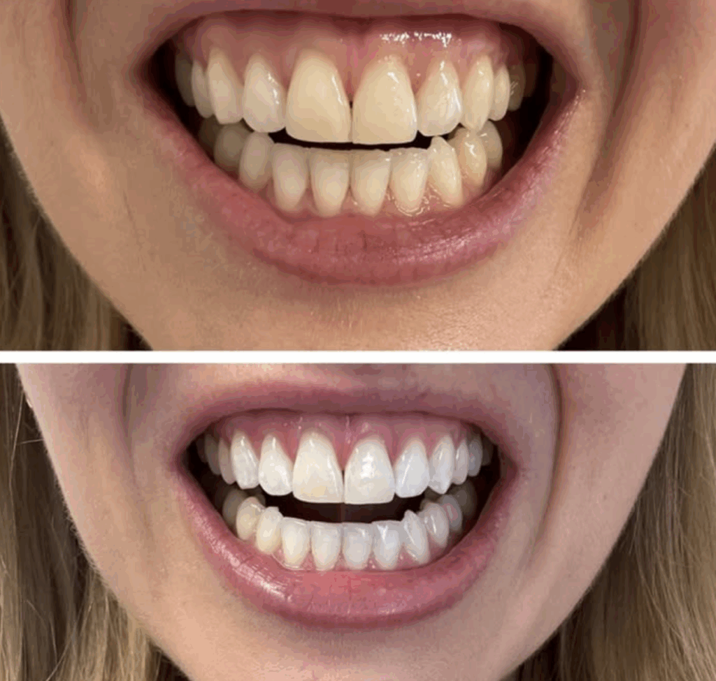 Common Myths About Whitening