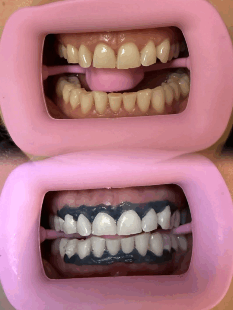 Do Teeth Go Back to Their Original Colour