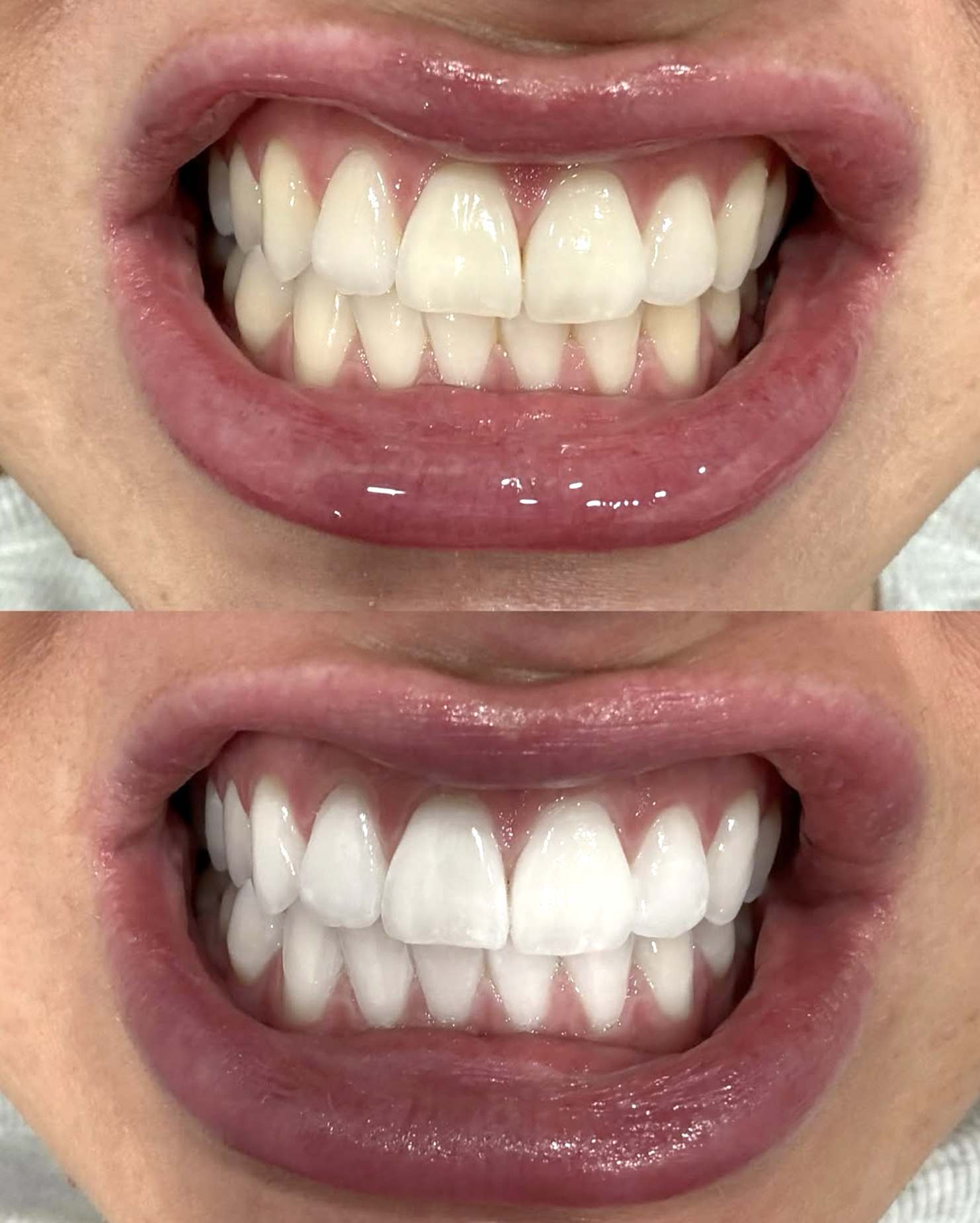 Do Teeth Return to Normal After Whitening